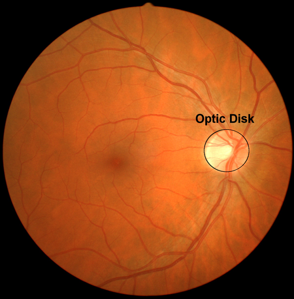Photograph of the back of the eye, highlighting the optic disk or blind spot.
